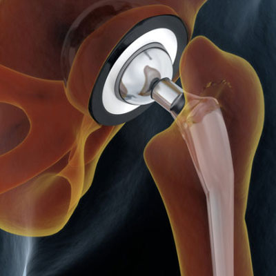 joint replacement surgery in Guntur